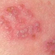 Illustration for article titled pengobatan herpes labialisem/em